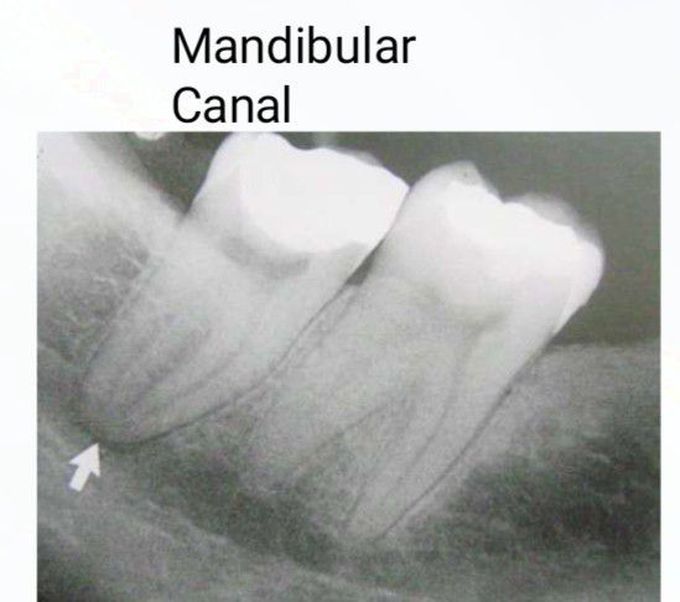 Mandibular Canal