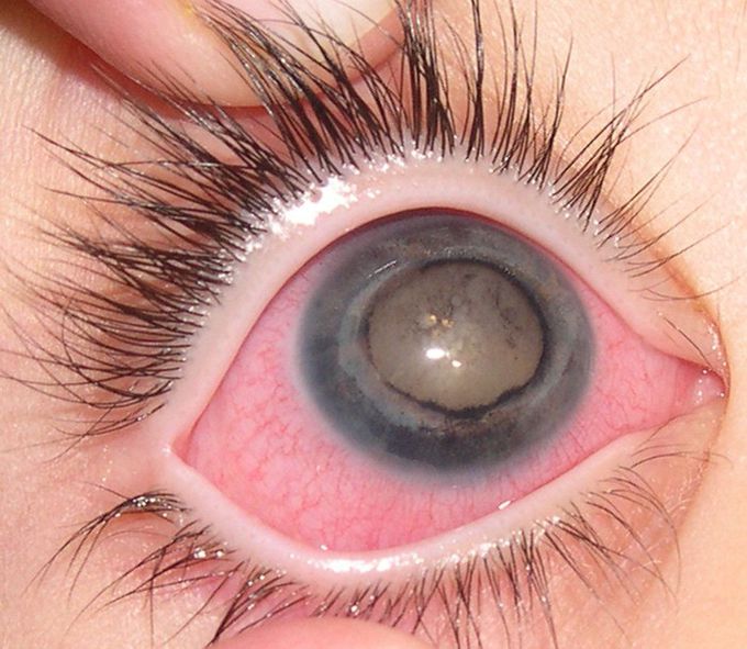 A strange eyes disease