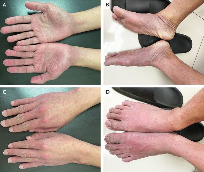 Papular–Purpuric “Gloves and Socks” Syndrome in Parvovirus B19 Infection