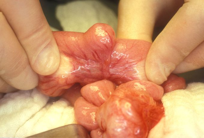 Meckel Diverticulum