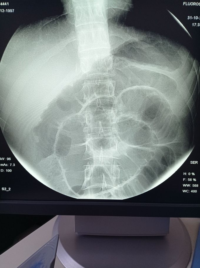 Acute bowel obstruction