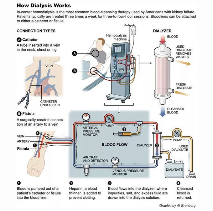 Know about Artificial kidney