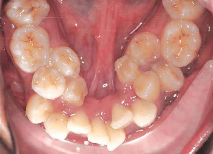 Supernumerary teeth