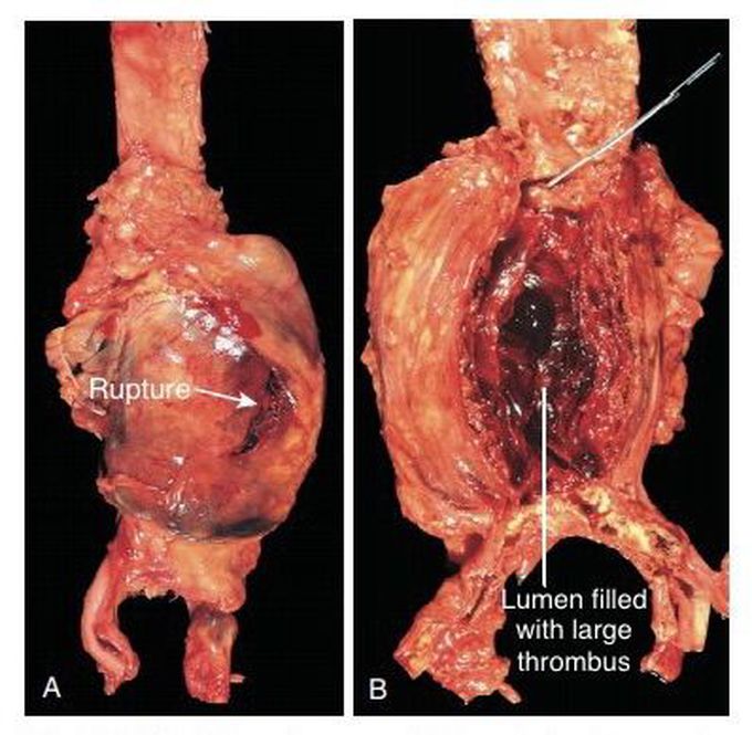 Abdominal aortic aneurysm