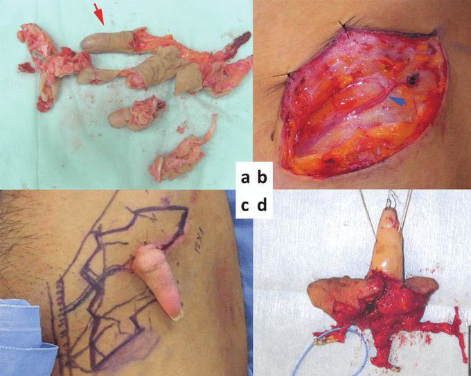 Temporary Ectopic Implantation of a Single Finger
Using a Perforator as a Feeding Vessel, and
Subsequent Prefabricated Chimeric Flap
Transplantation
