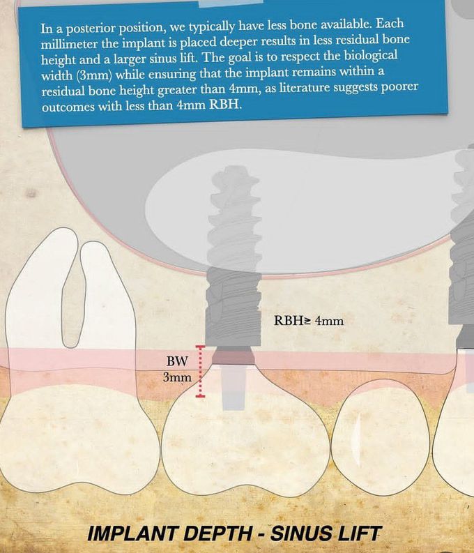 Implant Depth- Posterior Teeth