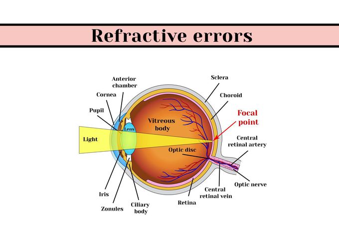 Refractive Errors