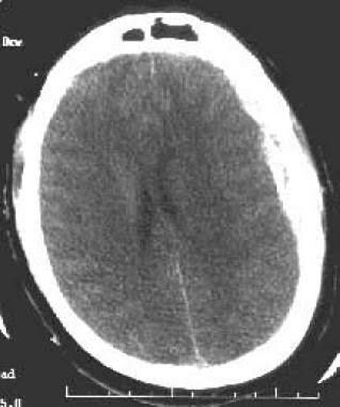 Subdural hematoma treatment