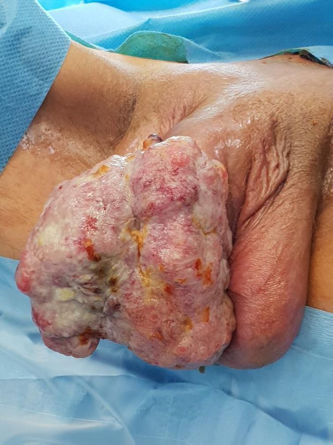 Penis tumor