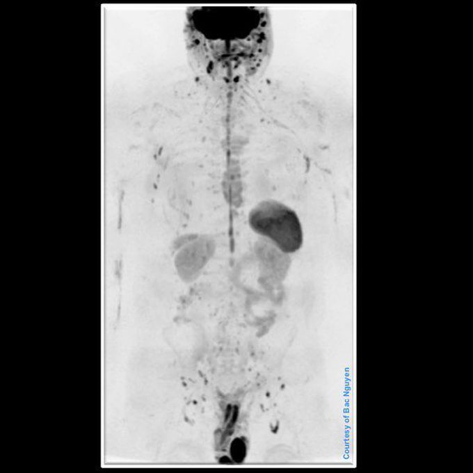 Whole Body Diffusion Weighted Imaging (WBDWI)