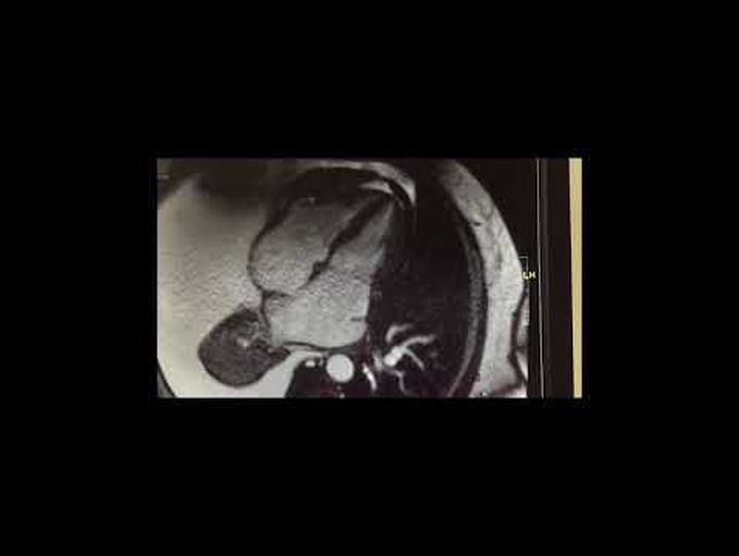 Management of Constrictive Pericarditis, Calcified Thickened Pericardium With Impaired Ventricles