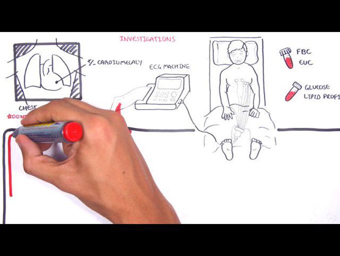 The pathophysiology of Acute Coronary syndrome
