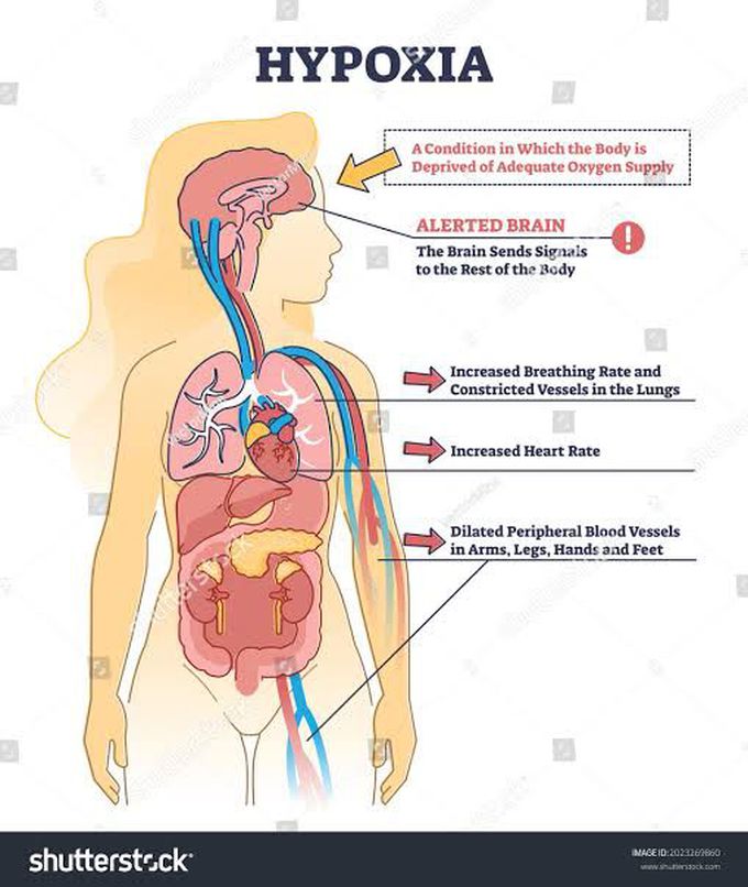 Hypoxia