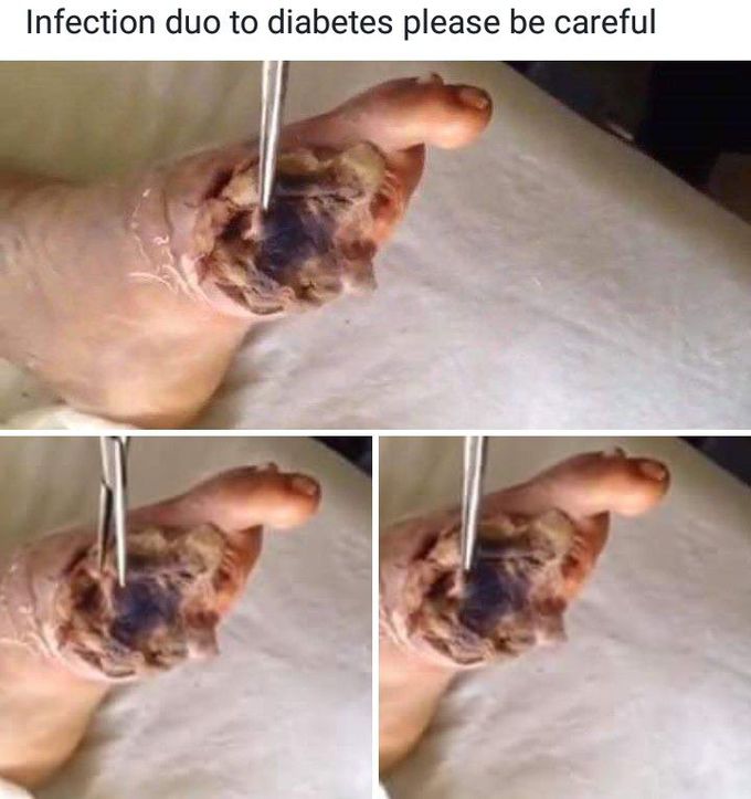 Diabetic foot