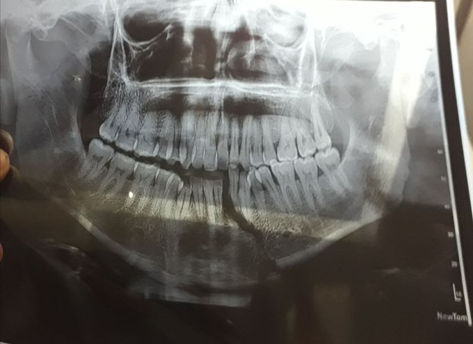 Mandible fracture