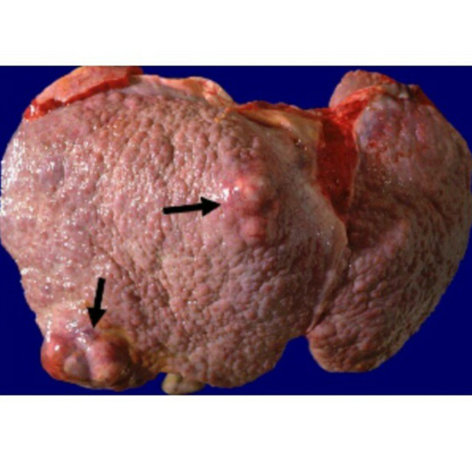 Liver