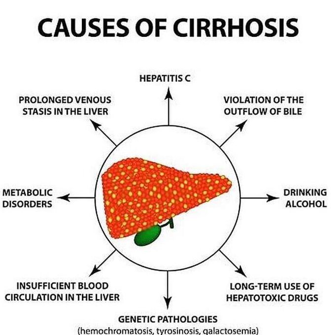 Consuming 3 ounces a day involves drinking 6 cans of beer, 5 glasses of wine, or 6 shots of liquor. About half the men who drink more than 8 ounces of alcohol a day for 20 years develop cirrhosis. Generally, the more and the longer people drink, the greater their risk of alcoholic liver disease.