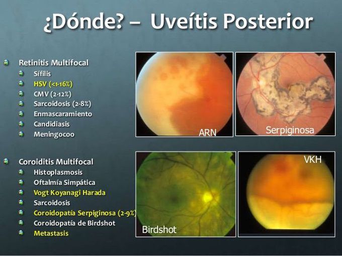 Uveitis posterior