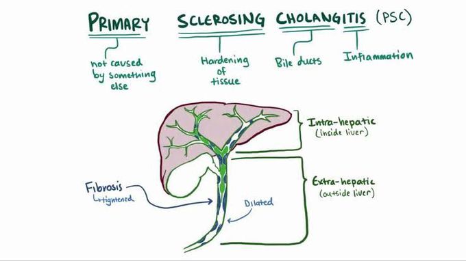 Primary sclerosing cholangitis