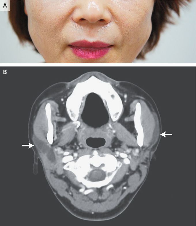 Saliva Firing from Parotid Ducts