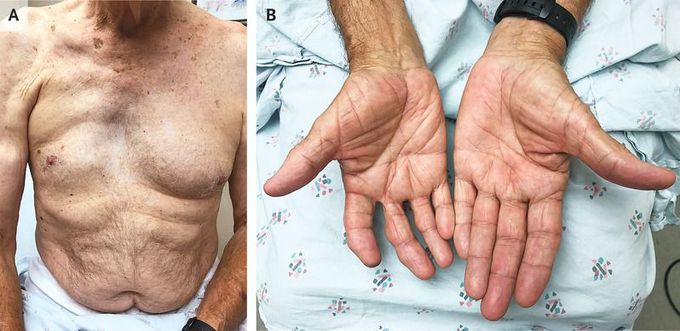 Poland Syndrome