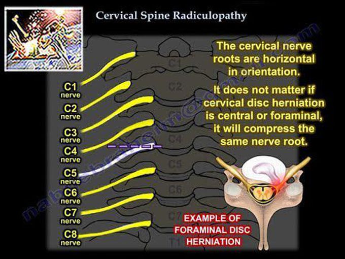 Cervical Radiculopathy - Everything You Need To Know - Dr. Nabil Ebraheim