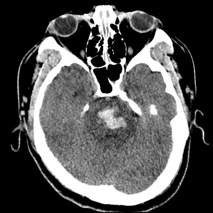 Pontine Hemorrhage: A Dreaded Complication of Chronic Hypertension