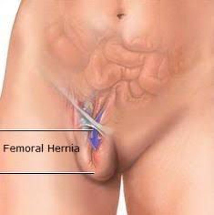 Symptoms of femoral hernia