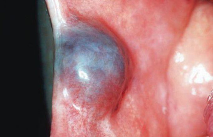 Vascular malformation of buccal mucosa