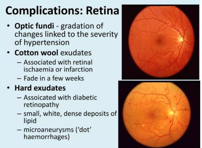 Hypertension Retinopathy -I