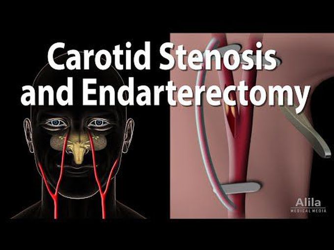 Carotid Endarterectomy-3D model