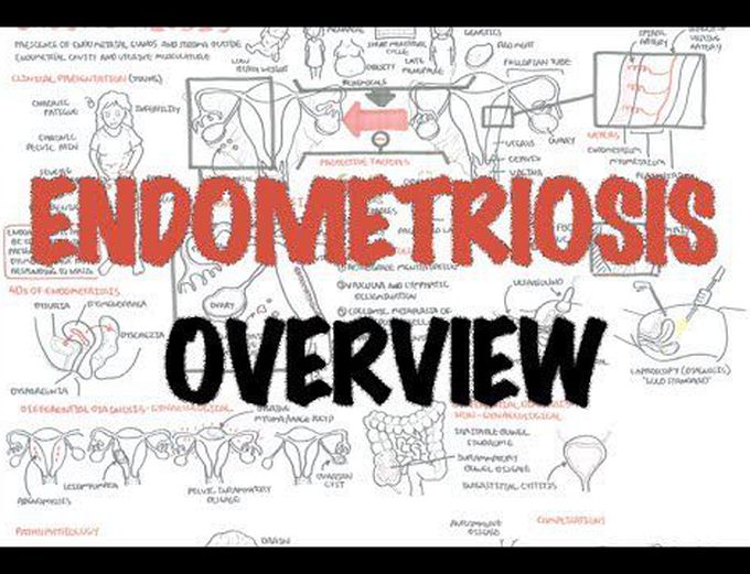 Endometriosis - Overview (pathophysiology, differential diagnosis, investigations and treatment)