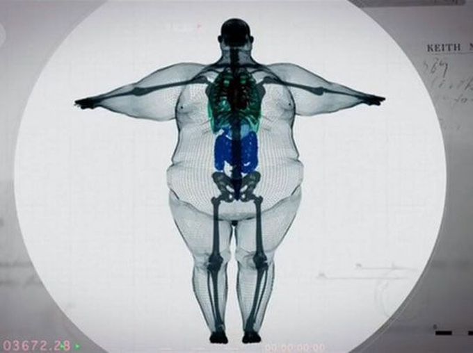 X-Ray Of A 900 Pound Man