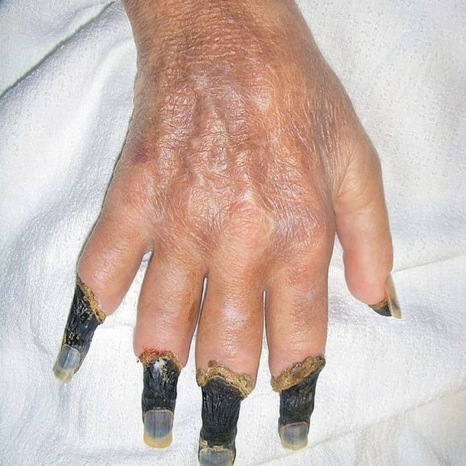Type II cryoglobulinemia