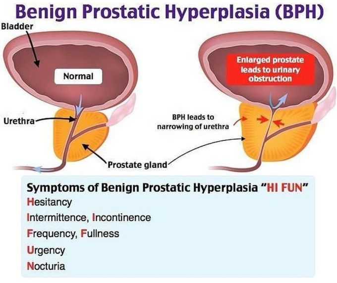 Benign Prostatic Hyperplasia