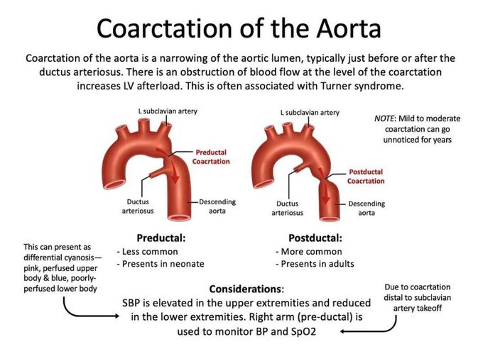Coarctation of Aorta