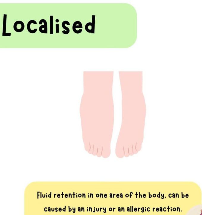 Localised Edema