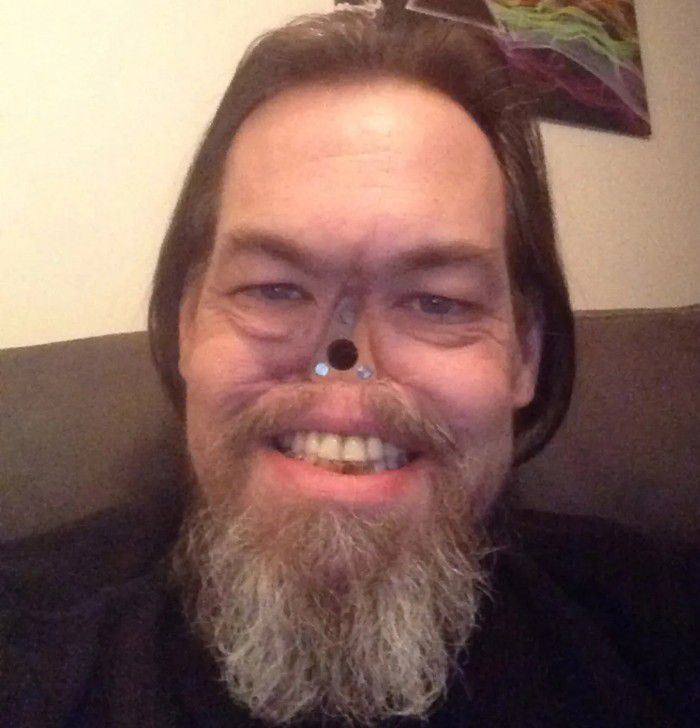 Nose Cancer MEDizzy