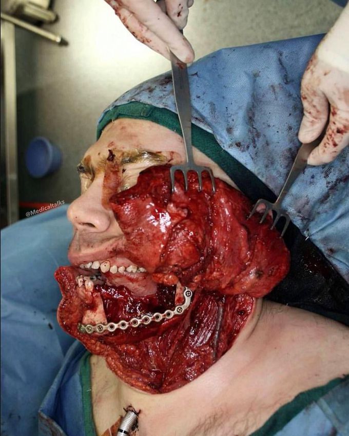 Jaw cancer