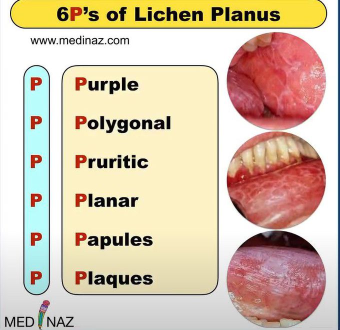Lichen Planus-mnemonic