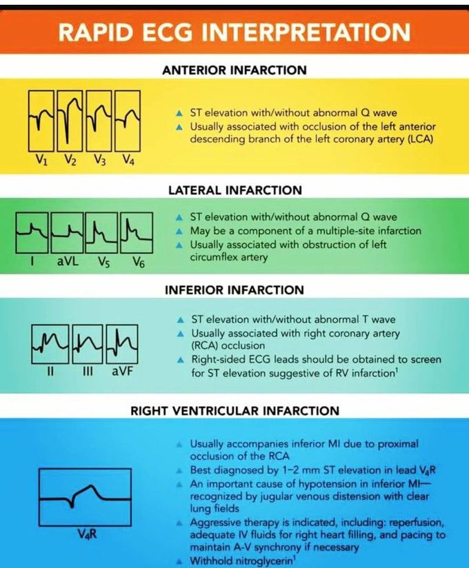 Rapid ECG Interpretation