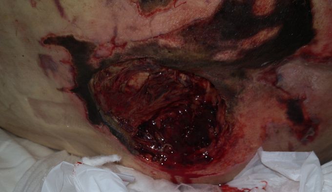 Sacral pressure ulcer stage 4