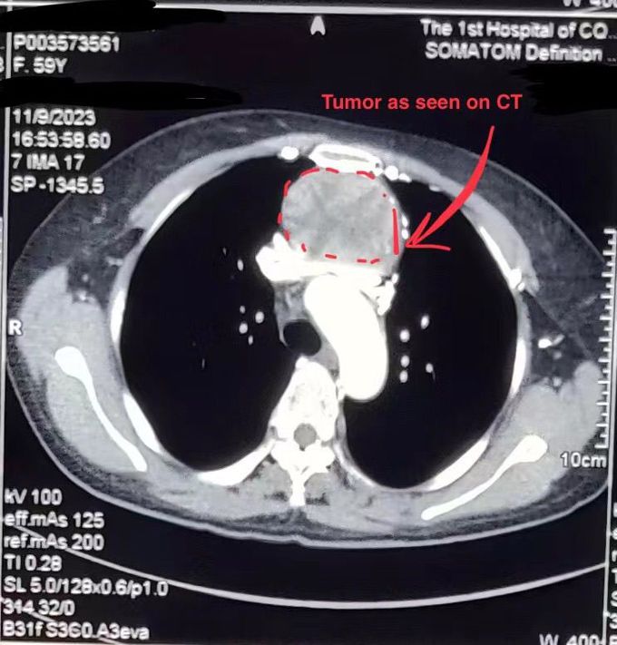 Mediastinal Tumor