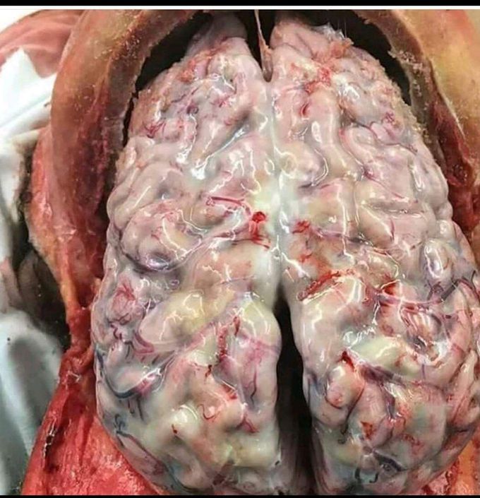 Brain with Meningitis