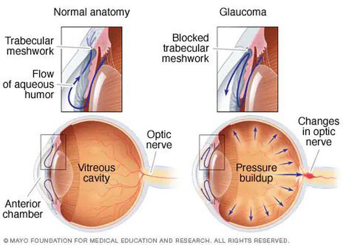 Acute open angle  glaucoma