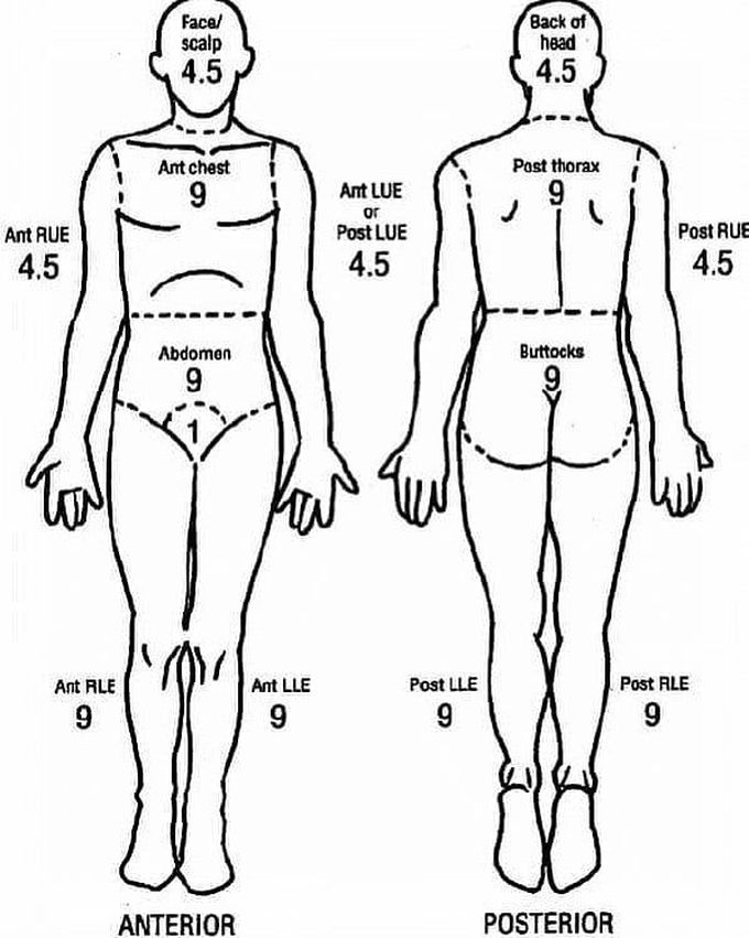 The rule of nines to calculate burns