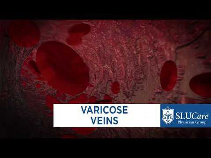 Varicose Veins-Treatment options