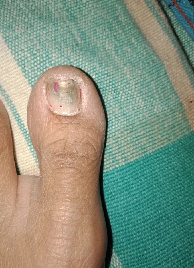 What time of treatment for this blackening of nail?  Need a help very soon