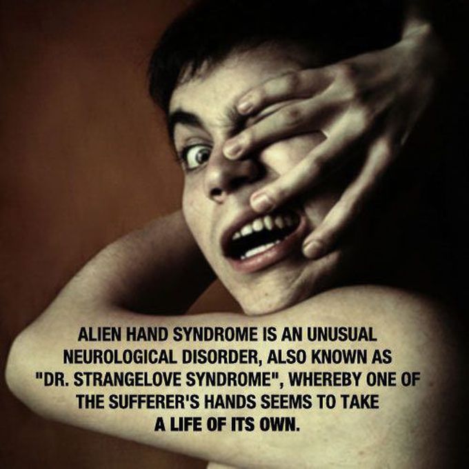 Alien Hand Syndrome Medizzy