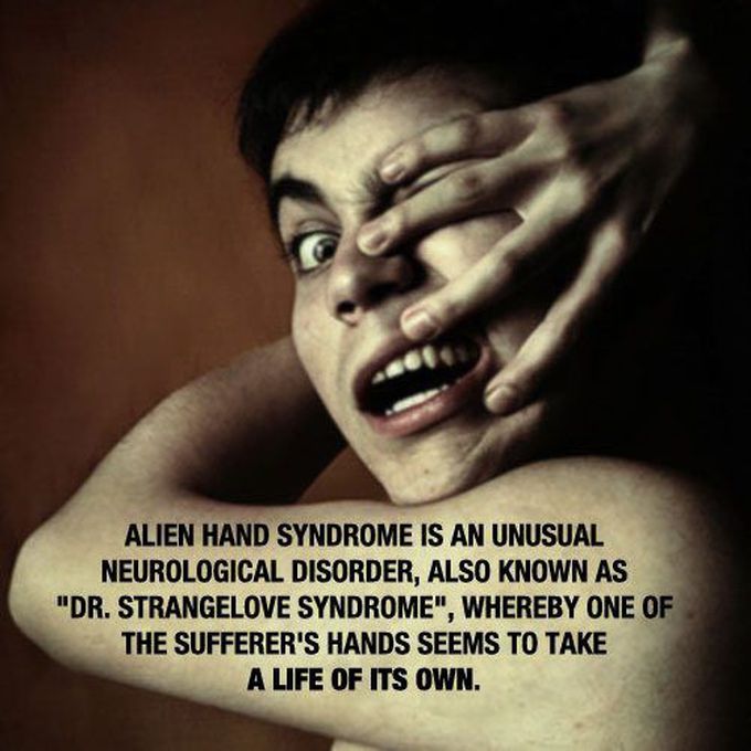 Alien hand syndrome